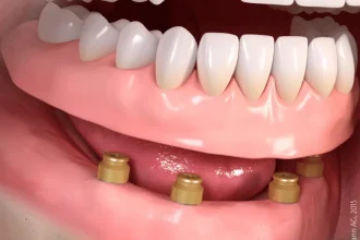 Bezzębie: jak brak zębów zmienia jedzenie i mowę oraz czym jest most na implantach